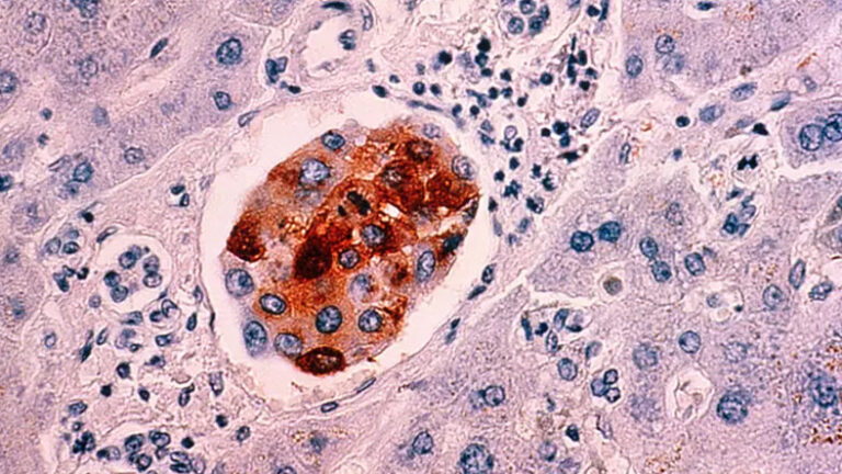 Göğüs Kanserini Teşhis Edebilen Mikroskobik Aygıt